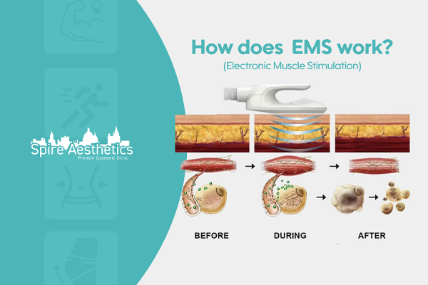 EMS treatment for post pregnancy weight loss treatment Stoke on Trent
