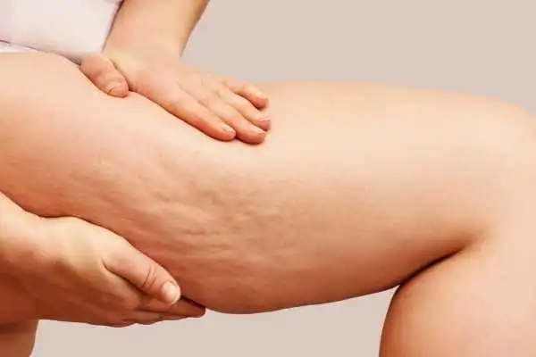 Image of woman showing leg with cellulite Stoke on Trent