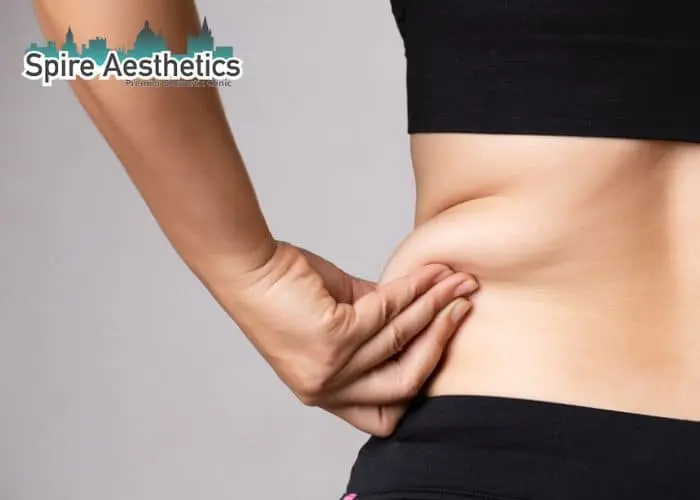 Image of woman pinching fat on their hips Stoke on Trent. Fat Freezing treatment