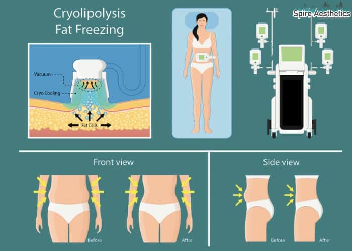 Image of diet and fat freezing combined for best results for Spire Aesthetics Stoke on Trent