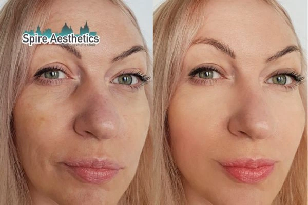 Morpheus8 Treatment Stoke on Trent Before & After Results