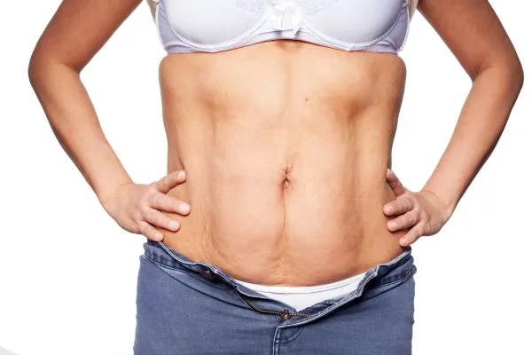sagging skin on woman's stomach after weight loss injections Stoke on Trent