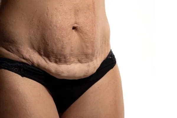 Image of womans stomach after weight loss injections Stoke on Trent showing saggy skin