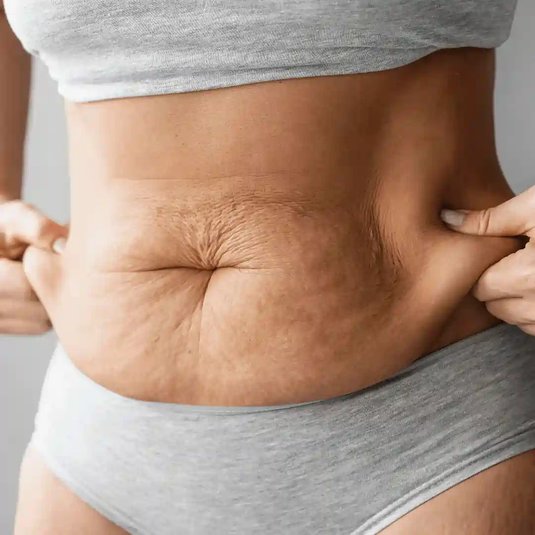 Is It Normal to Have Loose Skin After Pregnancy Stoke on Trent?