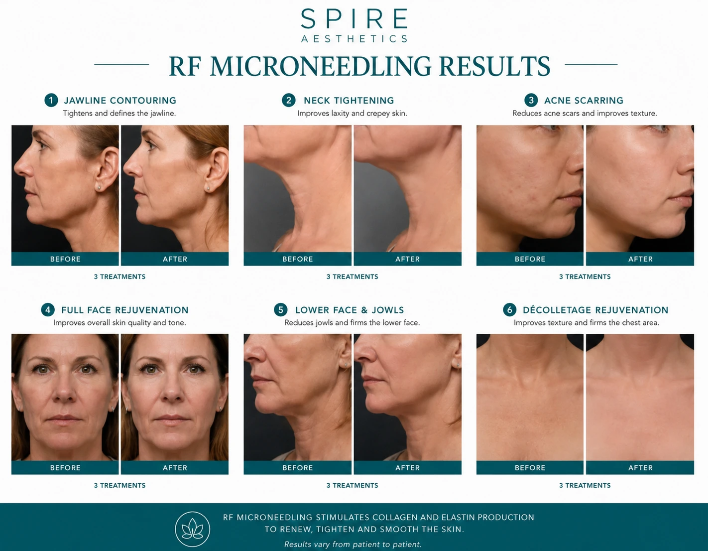 RF Microneedling Skin tightening Stoke on Trent results