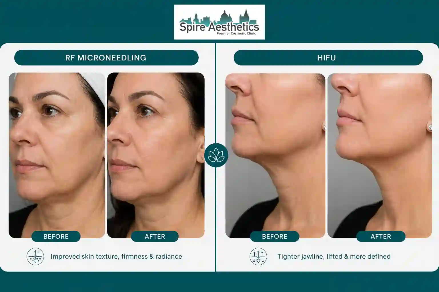 Can RF Microneedling and HIFU Be Combined Stoke on Trent?