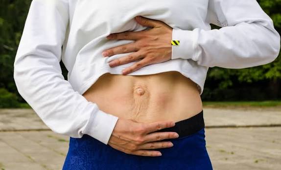 When Could Diastasis Recti Be the Missing Piece of the Puzzle Stoke on Trent?