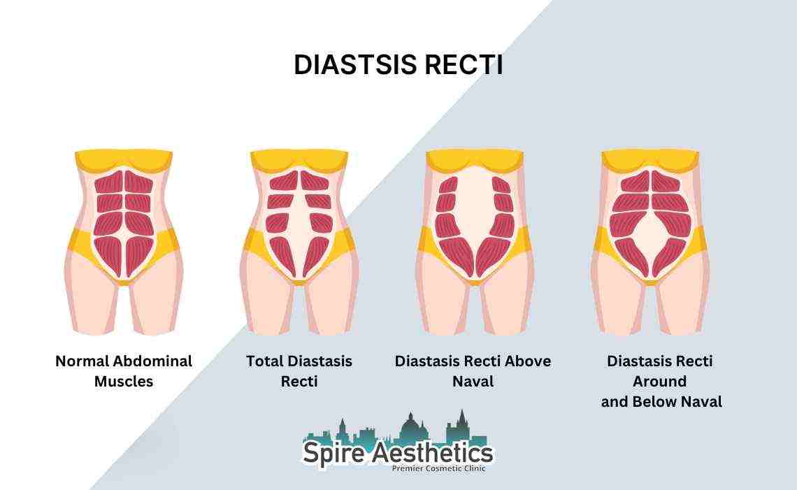 Is Non-Surgical Diastasis Recti Treatment Right for You? Common Concerns Answered Stoke on Trent